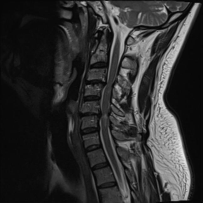 Anterior Cervical Discectomy Fusion